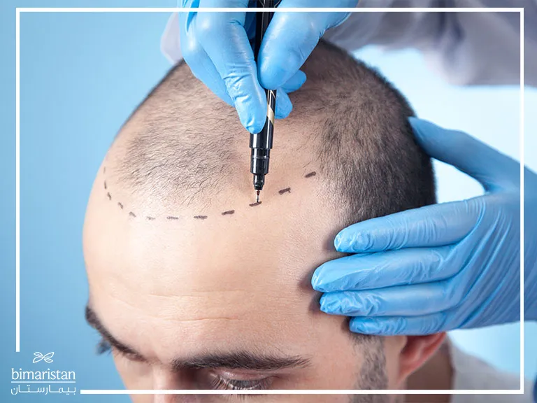 صورة تبين تحديد خط نمو الشعر في مقدمة فروة الرأس قبل زراعة الشعر بطريقة نيوجرافت