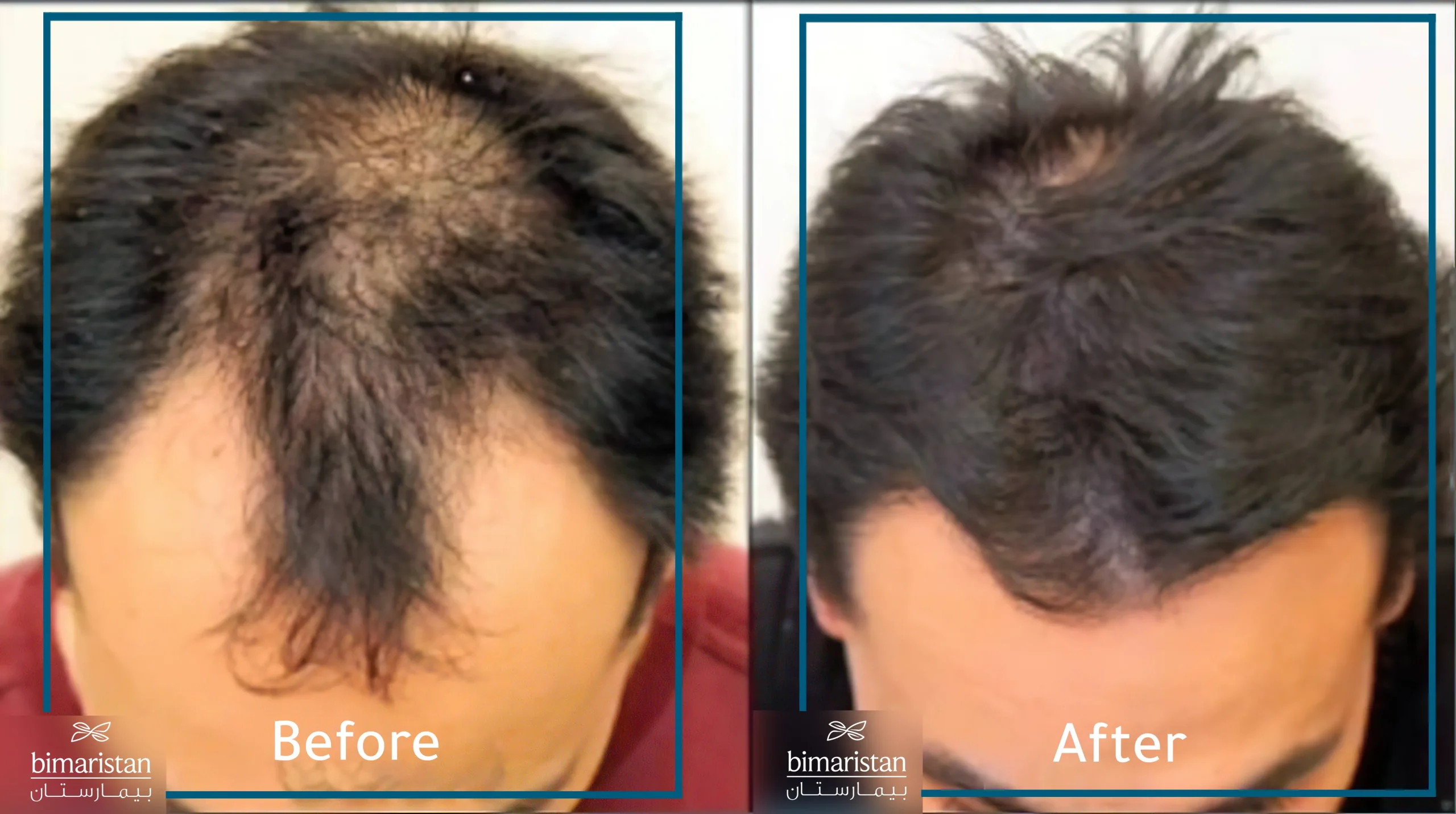 صورة لمريض مصاب بالصلع قبل وبعد إحراء عملية زراعة الشعر بطريقة نيوجرافت