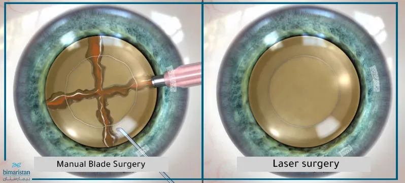 Laser-assisted cataract surgery vs traditional