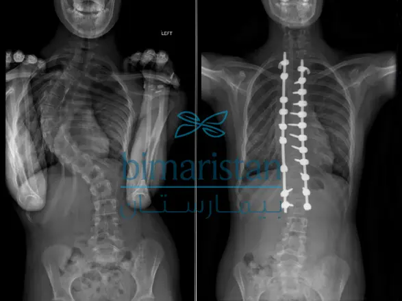 Radiograph showing the two parallel rods used to stabilize the spine in the Cottrell-Dubocet procedure