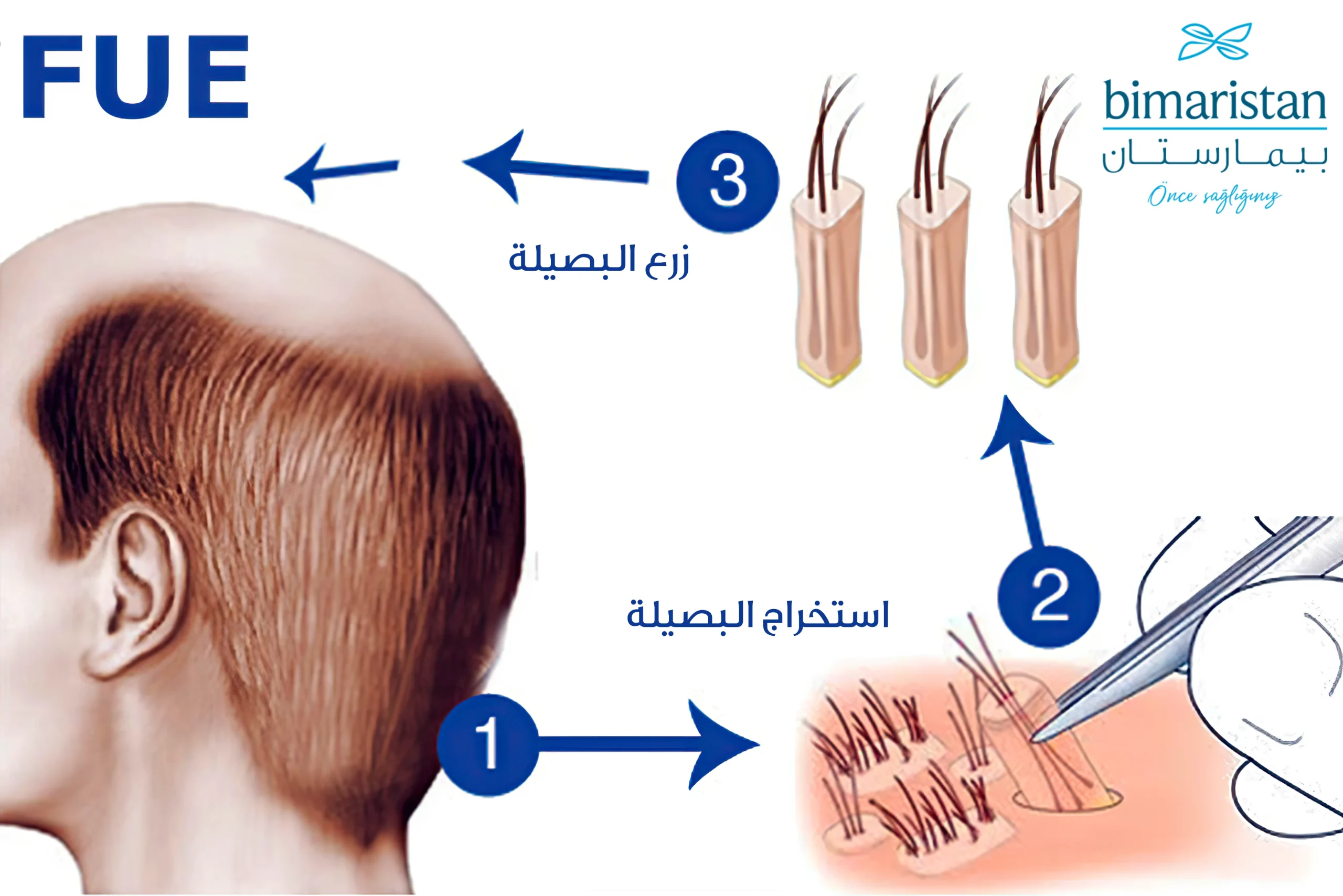 تقنية FUE لزراعة الشعر - زراعة الشعر بالاقتطاف