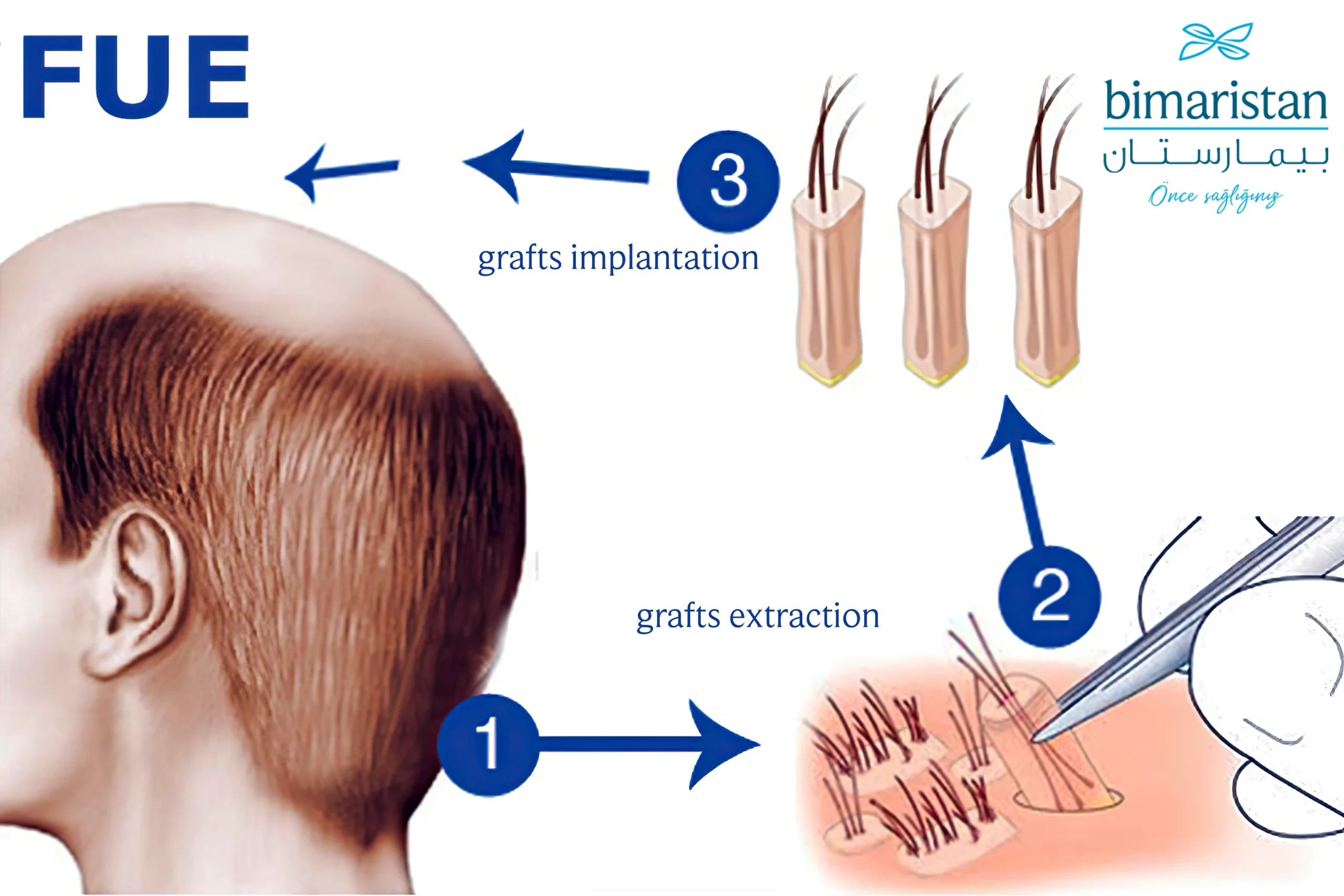 Follicular Unit Extraction hair transplant in Turkey