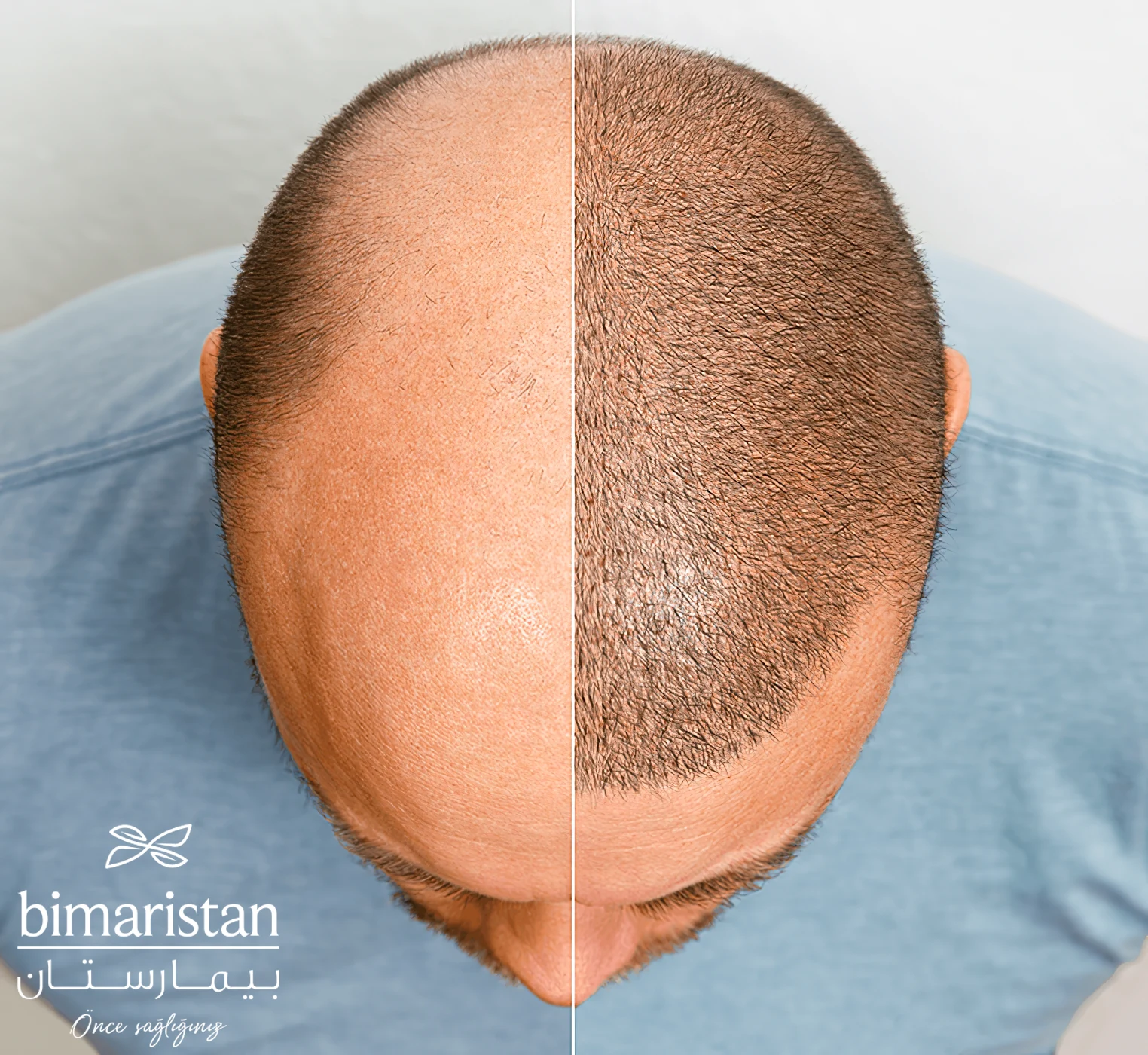 صورة لشعر رجل قبل وبعد إجراء تقنية FUE لزراعة الشعر