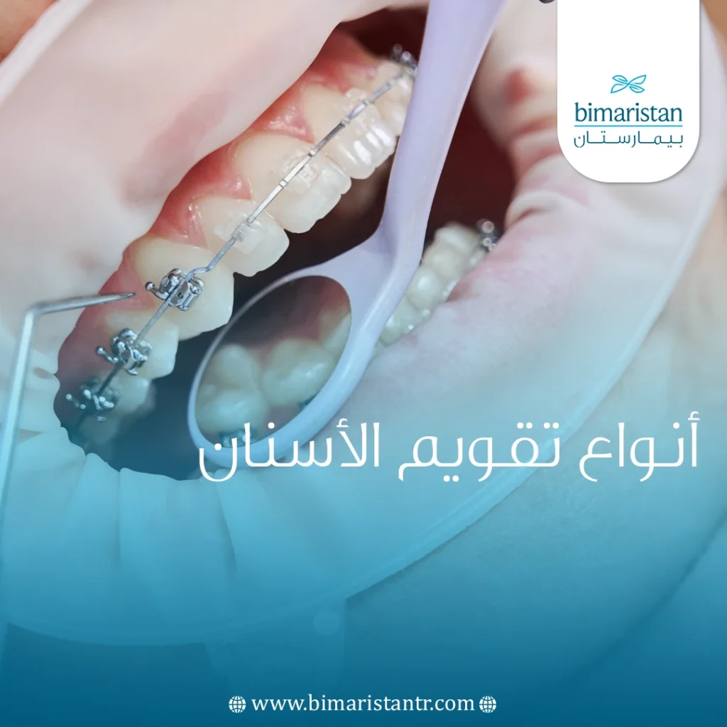 The best types of orthodontics in Turkey