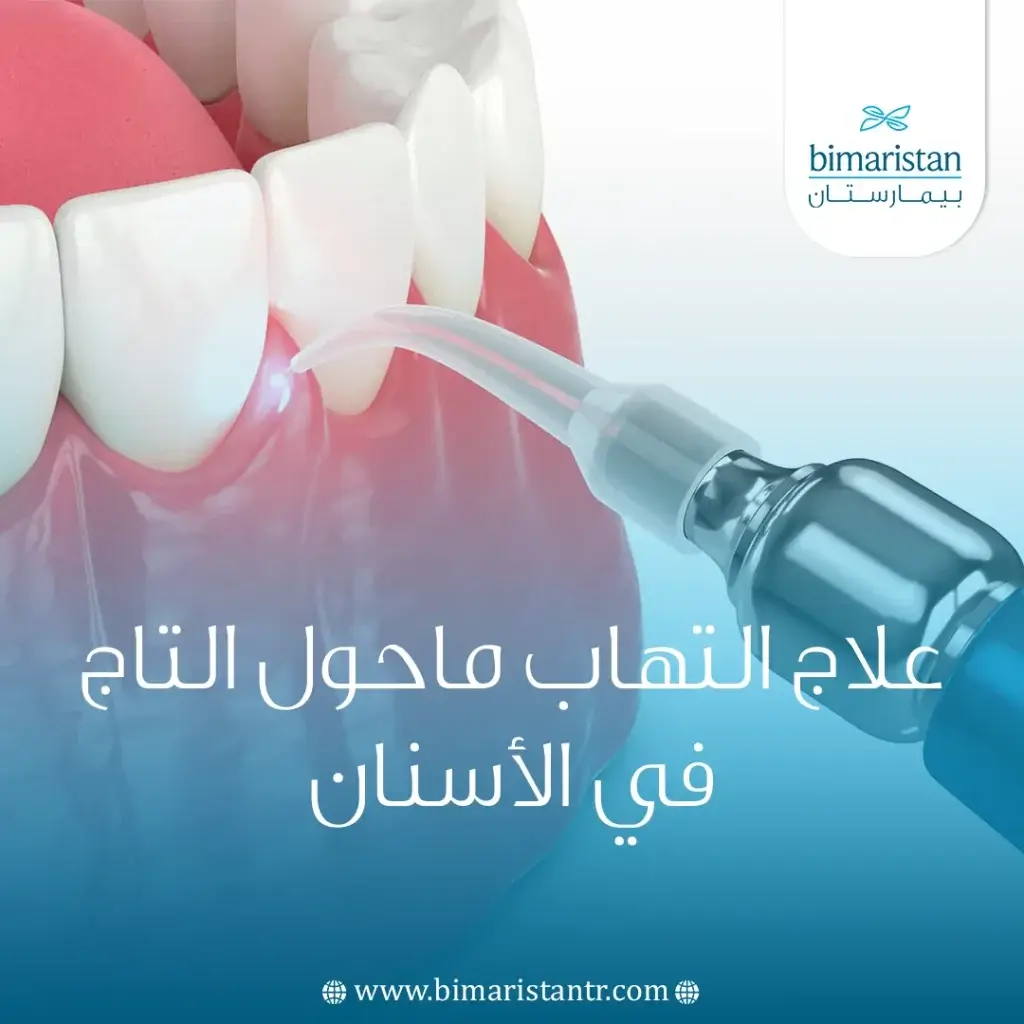 علاج التهاب ما حول تاج الأسنان في تركيا
