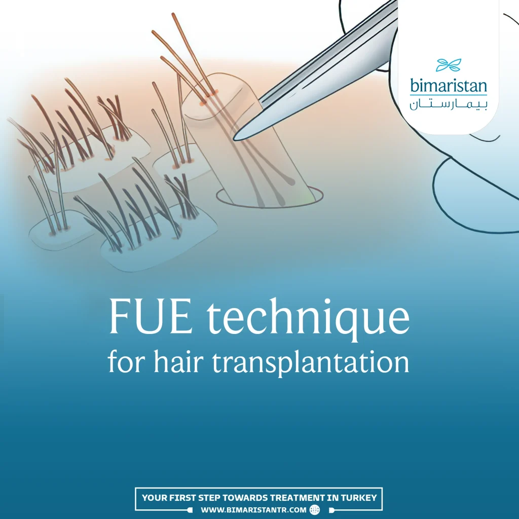 cover image for the FUE Hair Transplant article