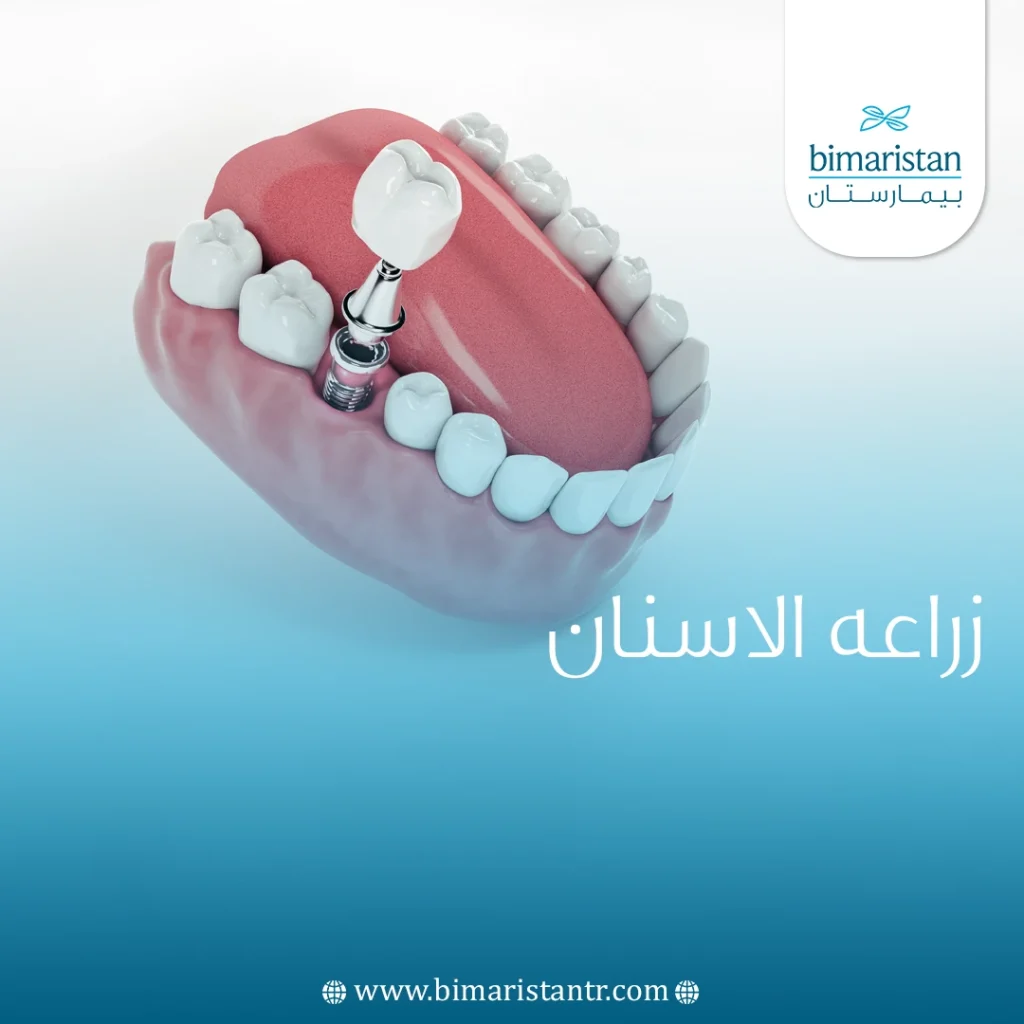 Dental implant surgery in Istanbul