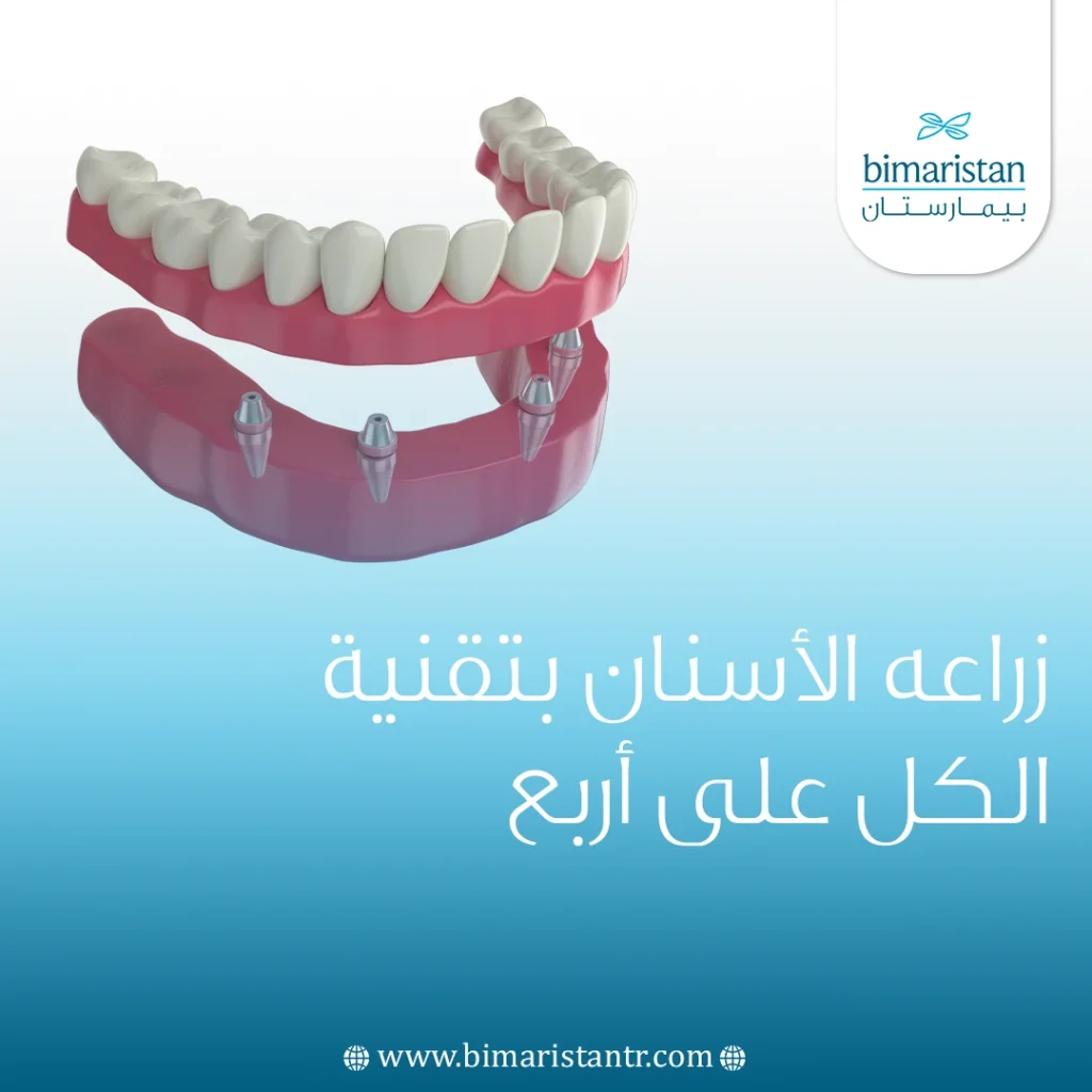Dental implants with all-on-four technology in Istanbul