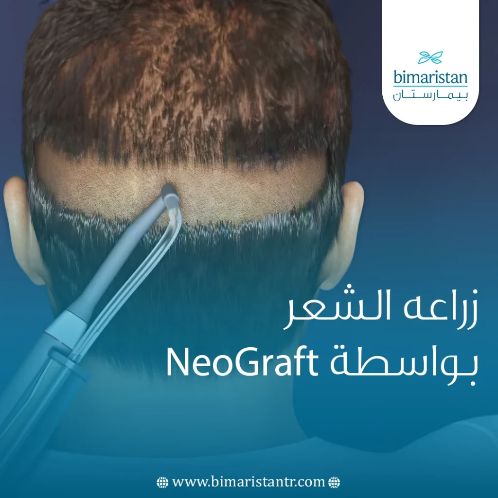 Hair transplantation with NewGraft