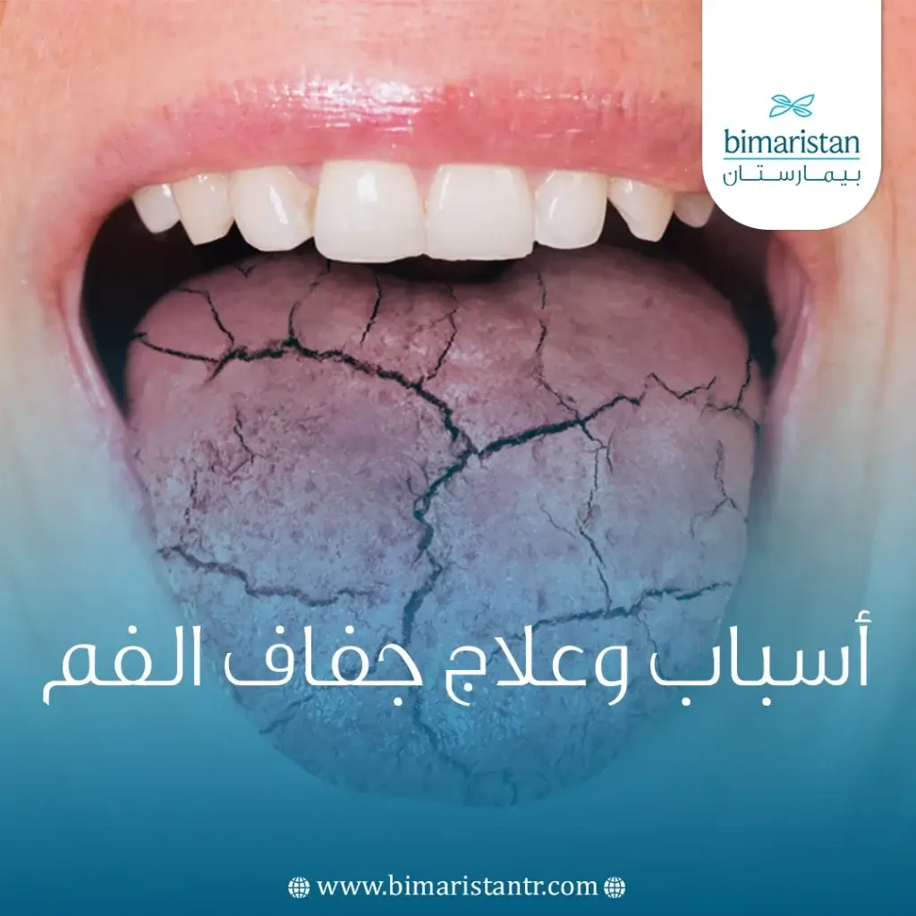 أسباب وعلاج جفاف الفم