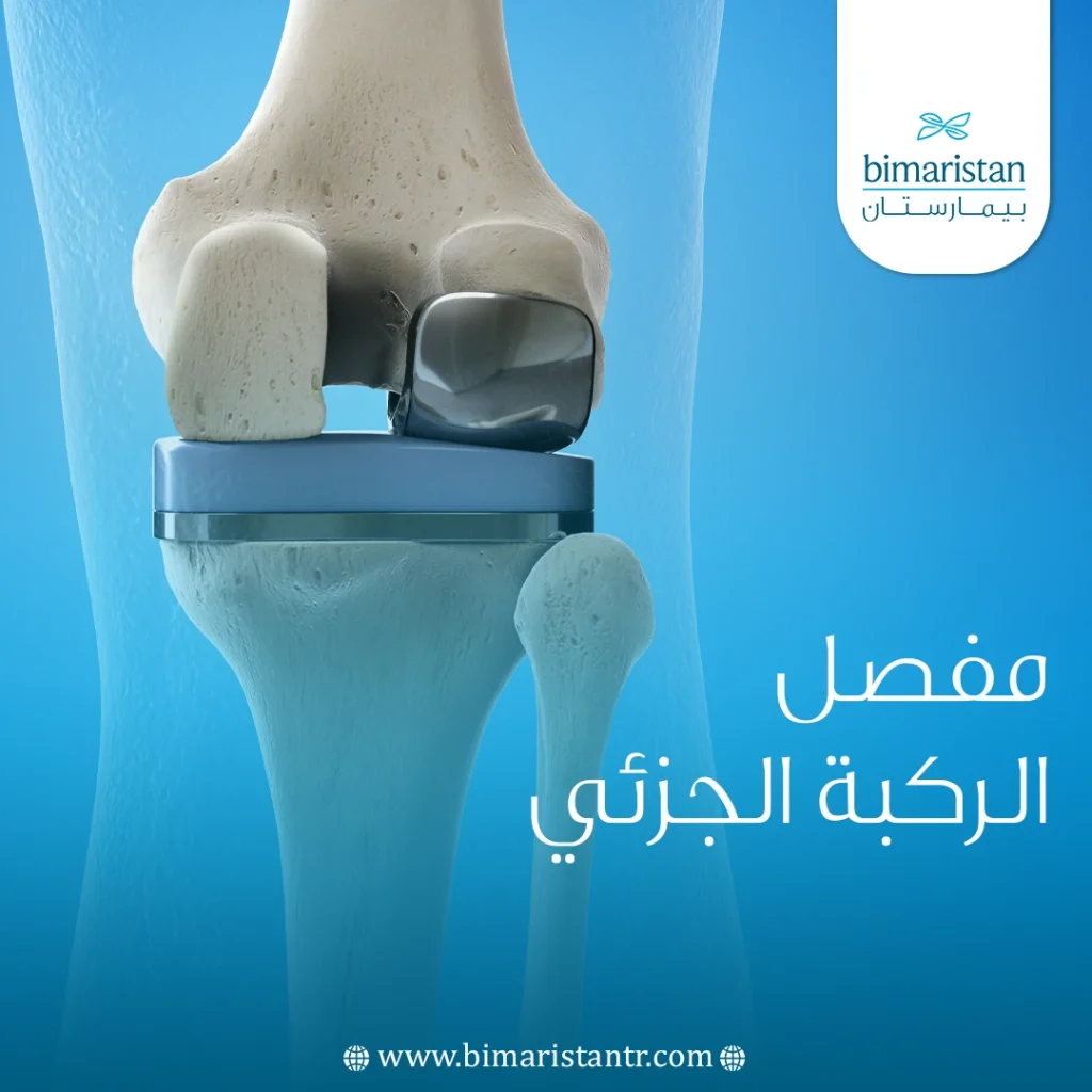 Partial knee joint replacement surgery
