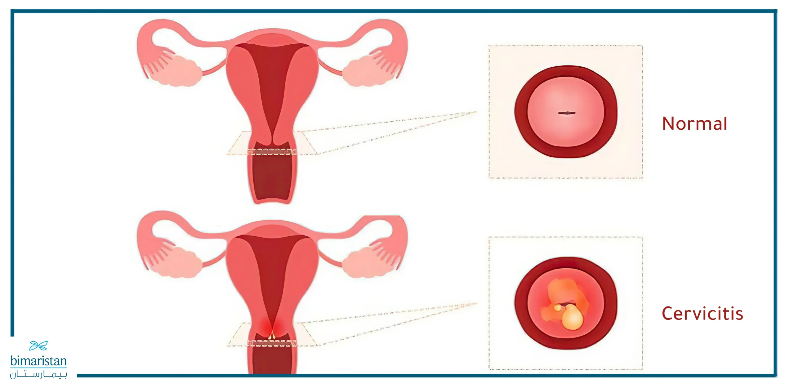 The difference between normal and inflamed cervix