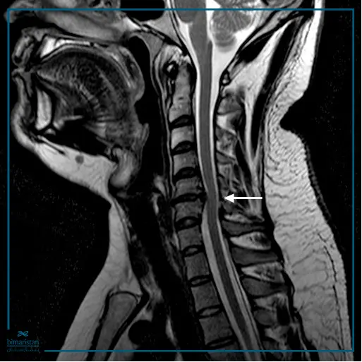 An MRI image showing a disc in one of the cervical vertebrae in a patient suffering from neck pain