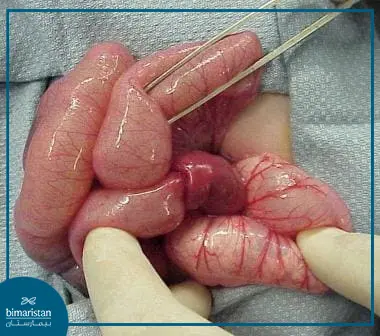 Infant intussusception in abdominal surgery