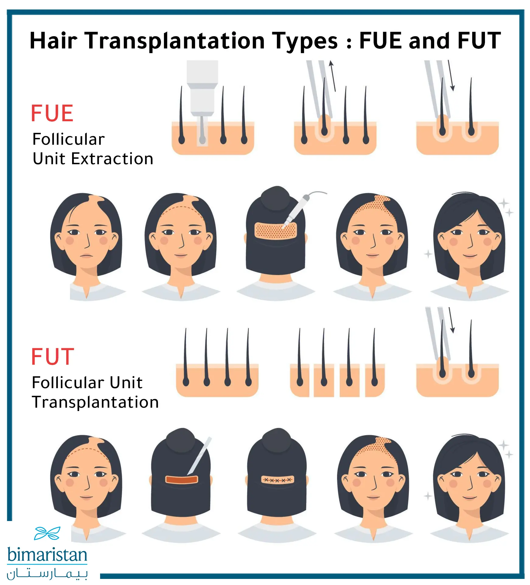 Fue And Fut Hair Implants For Women