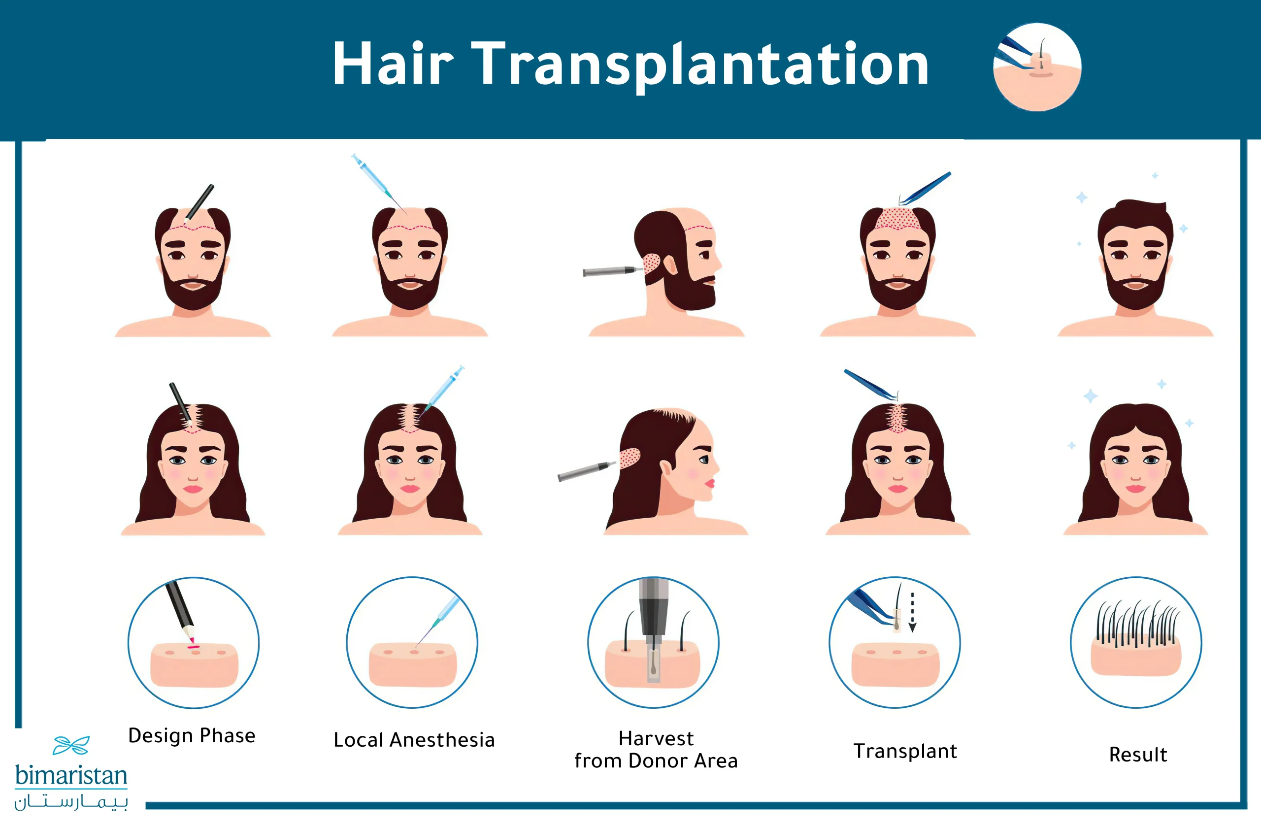 Hair Replacement For Women In Turkey