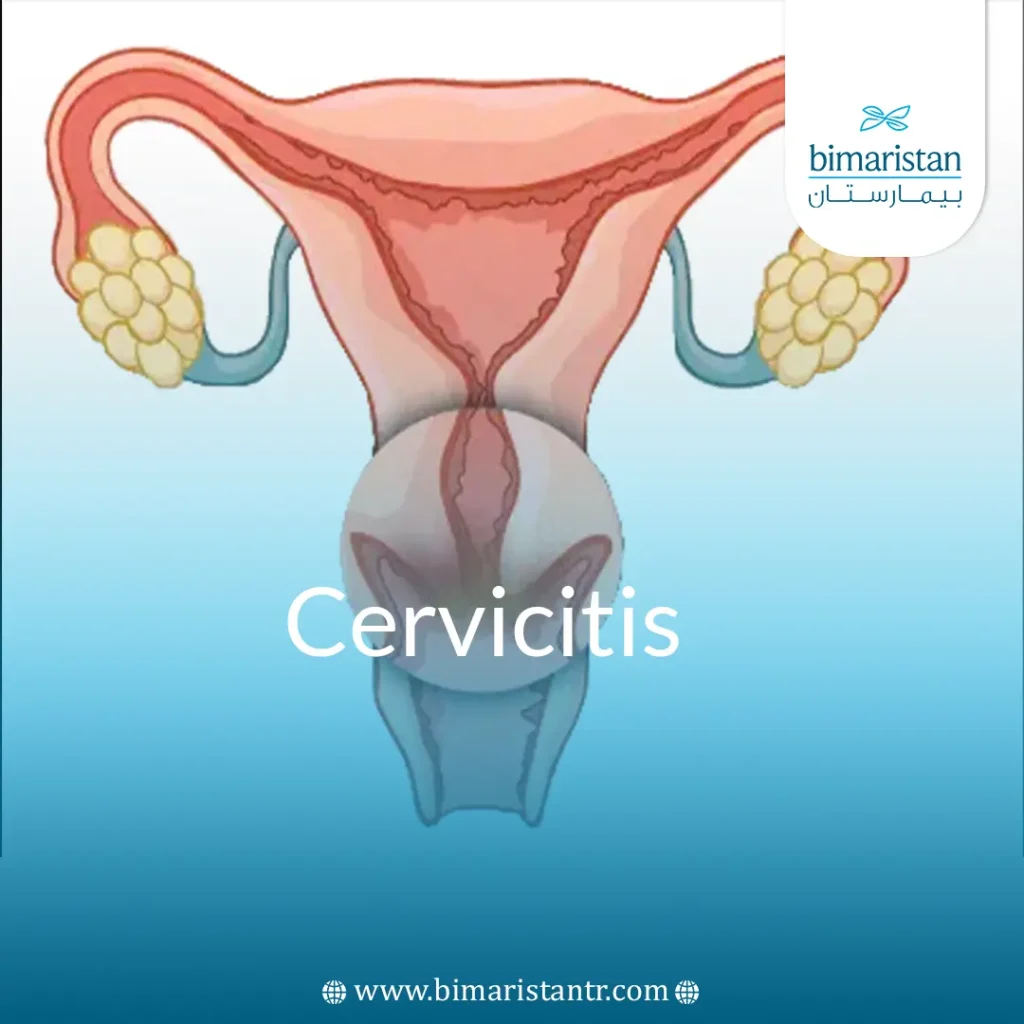 Cover image for the Cervicitis article