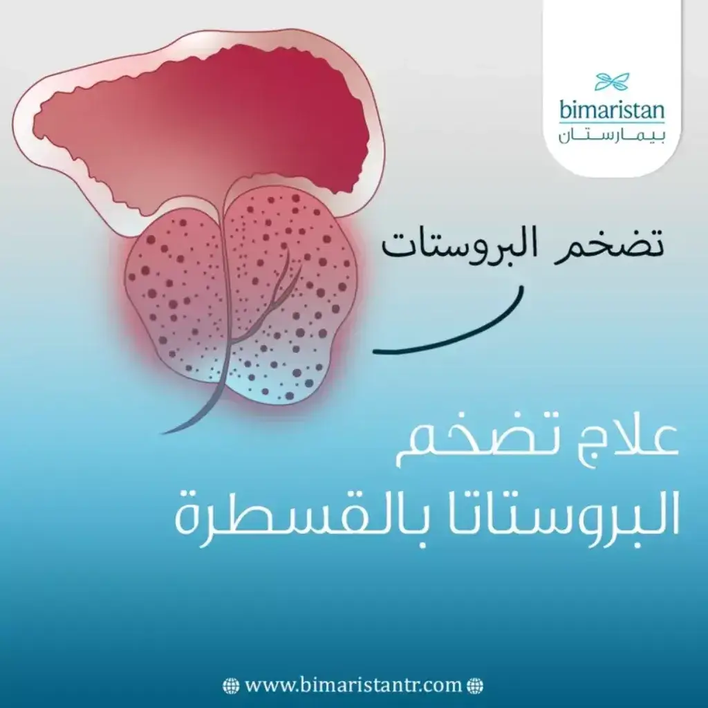 عملية قسطرة البروستاتا في تركيا