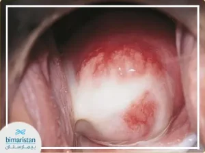 abnormal cervix pictures (cervicitis pictures)