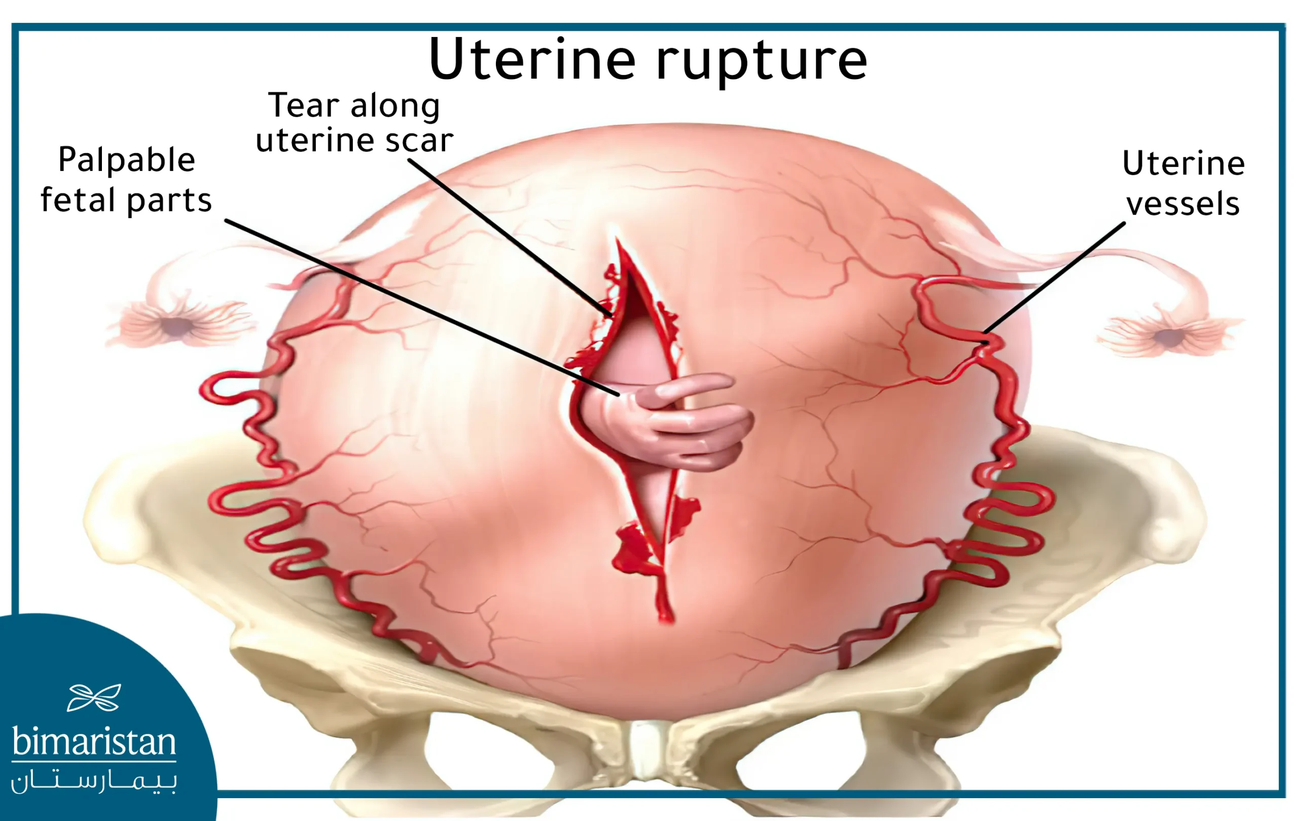 most common sign of uterine rupture