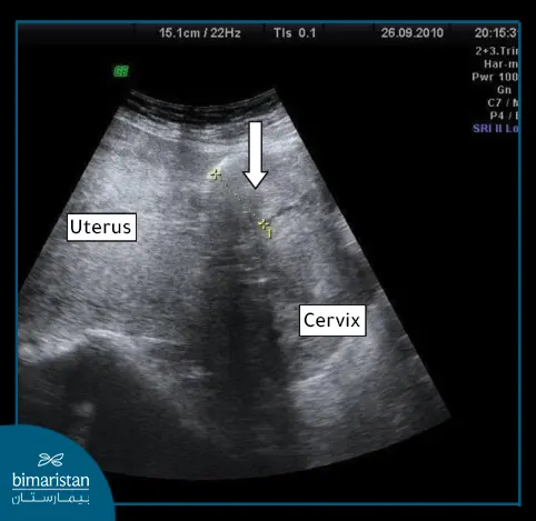 uterine tear on the ultrasound image