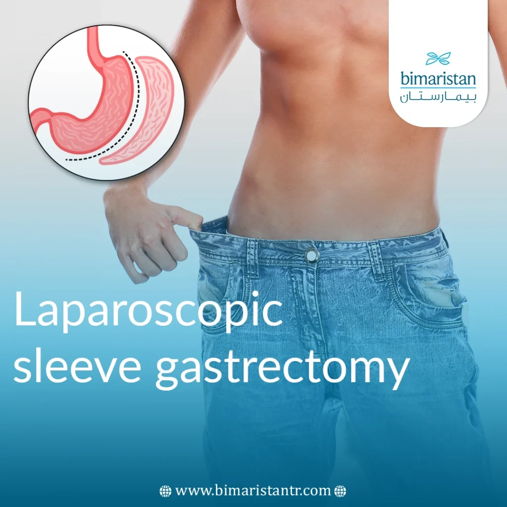 Laparoscopic sleeve gastrectomy