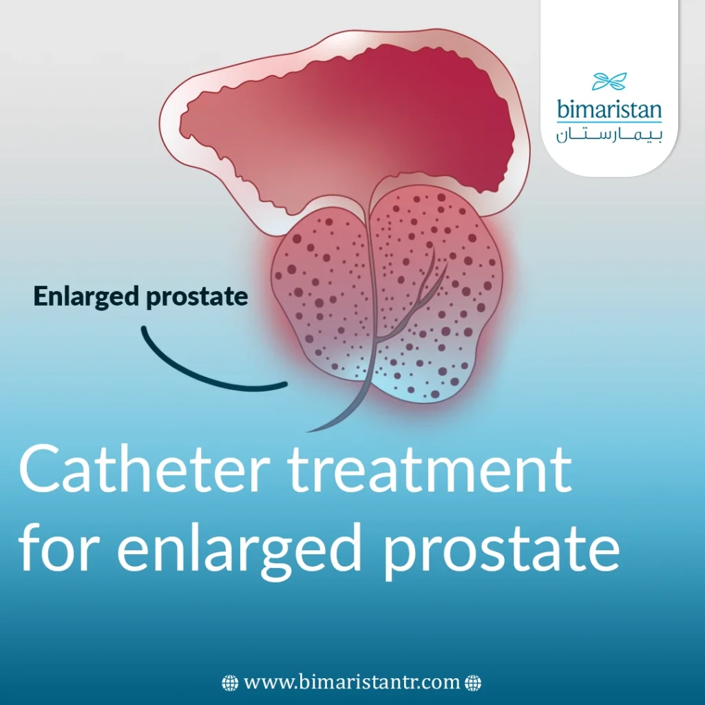 catheter treatment for enlarged prostate
