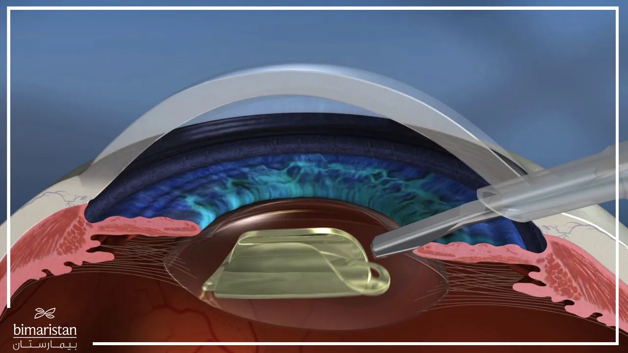 Artificial lens implant