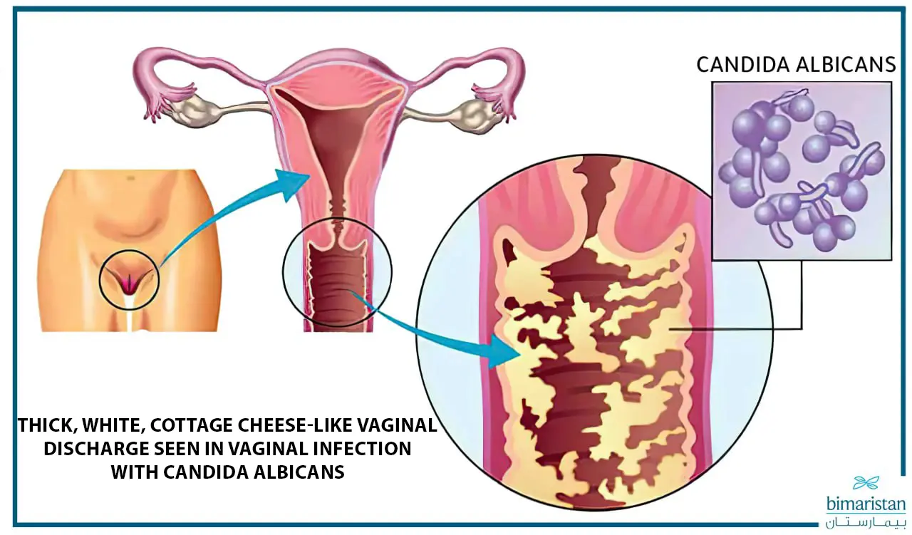 A picture illustrating the yeast fungi in the vaginal discharge of candidiasis.