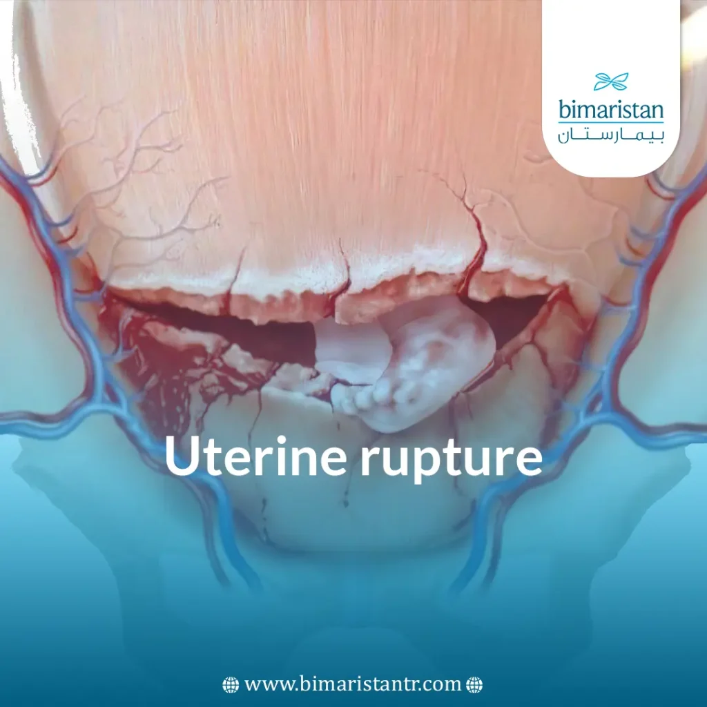 Cover image for a uterine rupture article