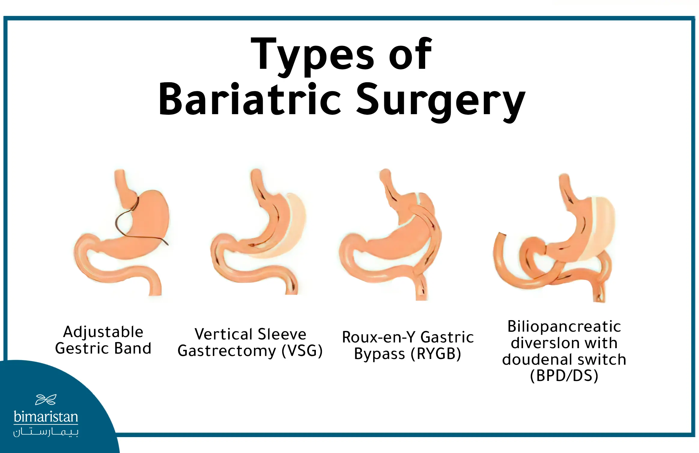 The different Types of bariatric Surgery in Turkey