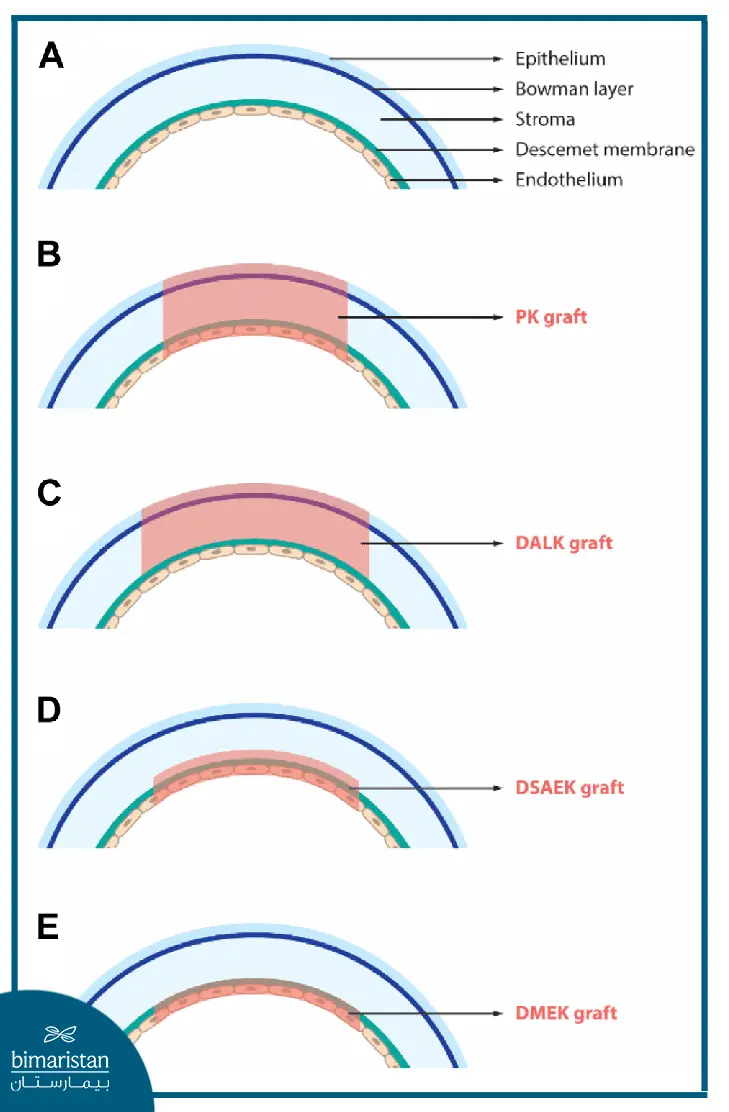 An image showing the types of corneal transplantation in Türkiye