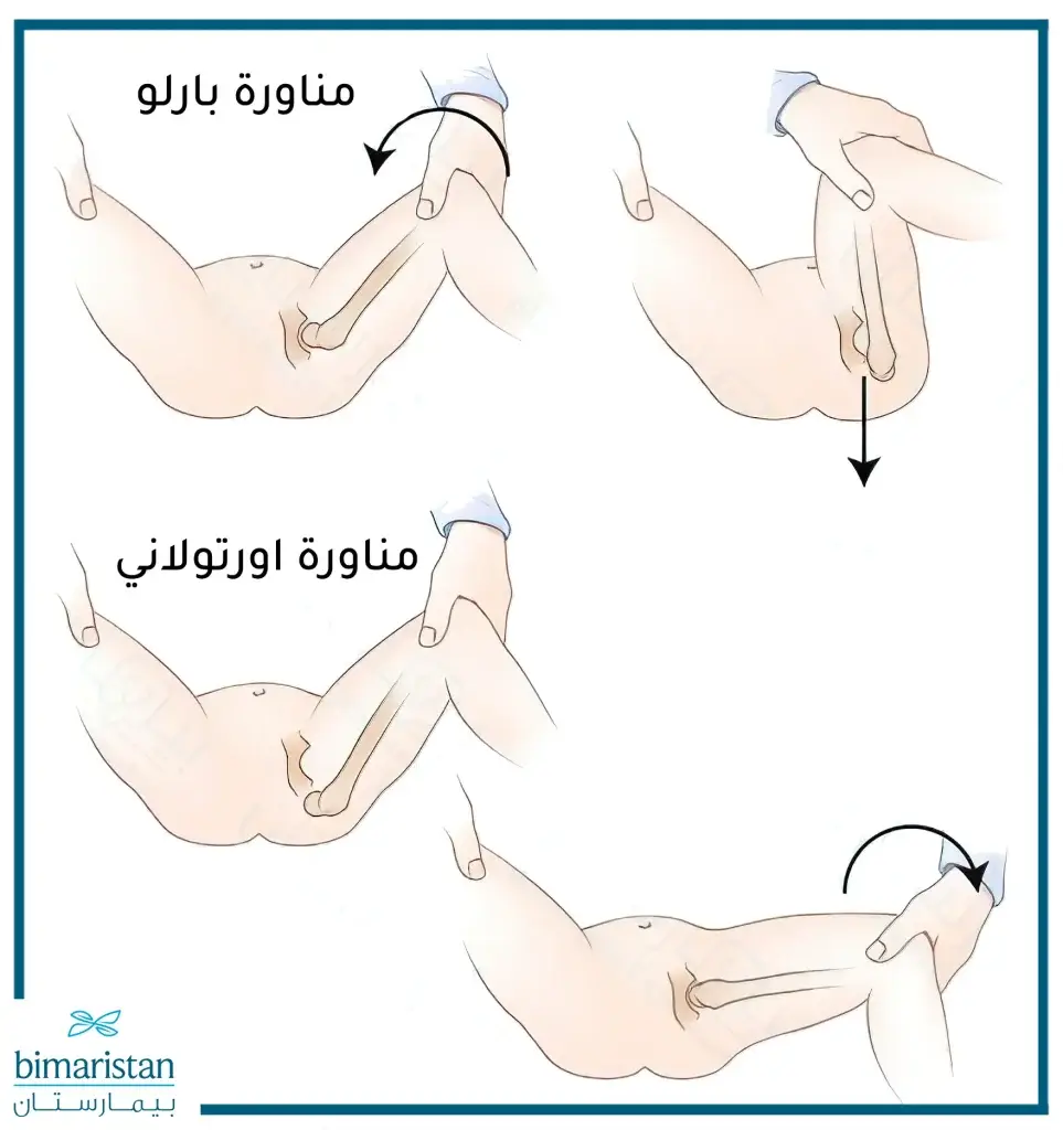 طريقة إجراء مناورة بارلو ومناورة أورتولاني لعلاج خلع الورك الولادي