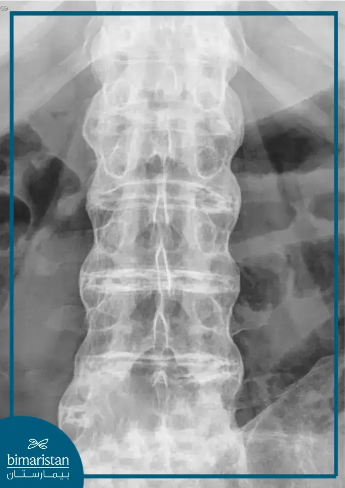 صورة شعاعية تبين مظهر ساق البامبو وهي وصفية لمرض التهاب الفقار اللاصق