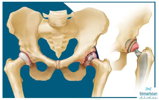 صورة توضح عملية استبدال مفصل الورك بشكل كامل نتيجة التهاب مفصل الورك