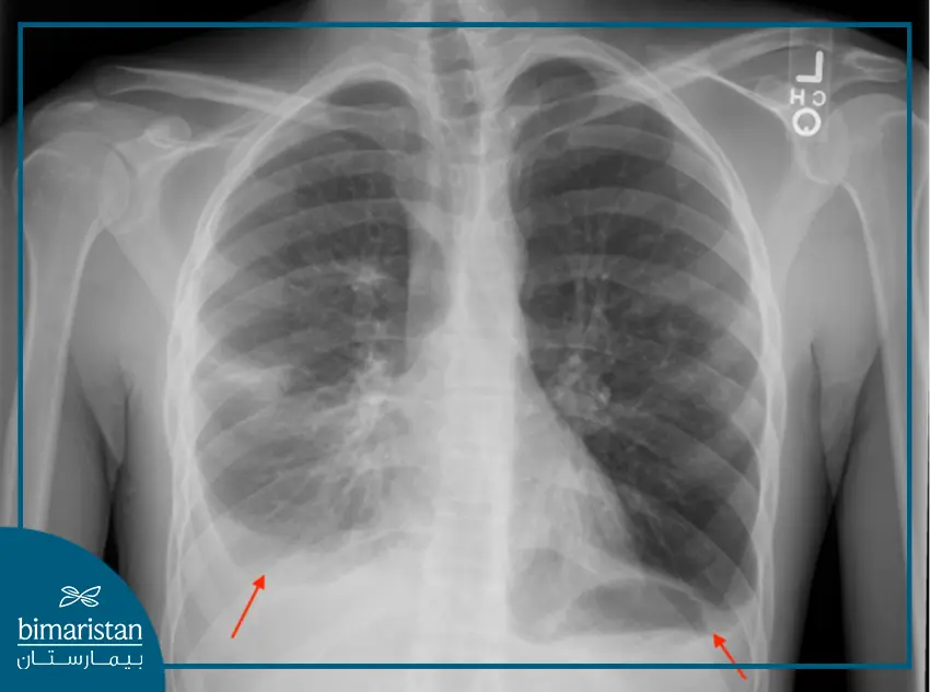 تشخيص الانصباب الجنبي عبر تصوير الصدر بالأشعة السينية (خط دموازييه)