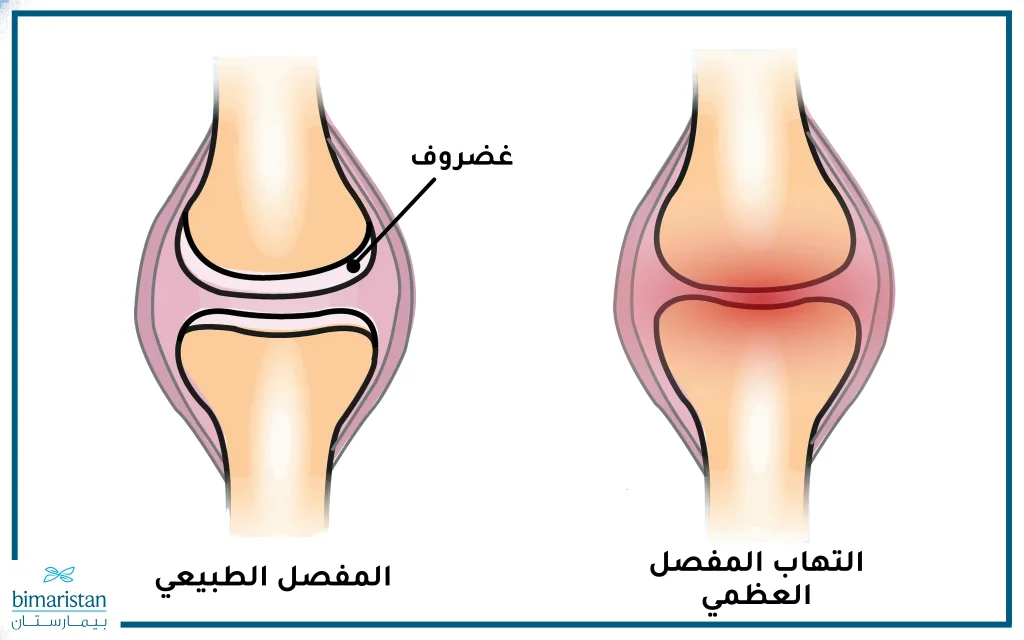 يمكن أن يؤدي مرض الفصال العظمي إلى حدوث تيبس المفاصل وخصوصاً في الركبتين