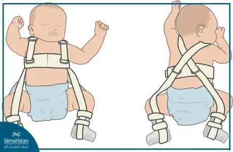 يستخدم سرج بافليك لتثبيت المفصل الحرقفي الفخذي عند الأطفال المصابين بخلع الورك الولادي
