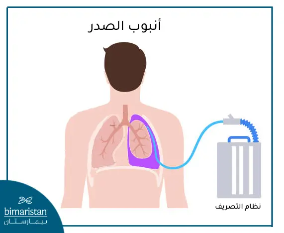 علاج الاسترواح الصدري عبر تفجير الصدر المغلق تحت الماء