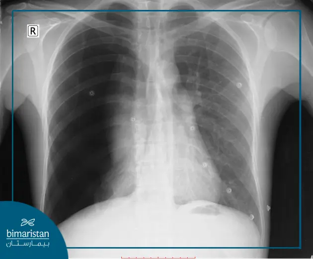 تشخيص استرواح الصدر عن طريق التصوير بالأشعة السينية