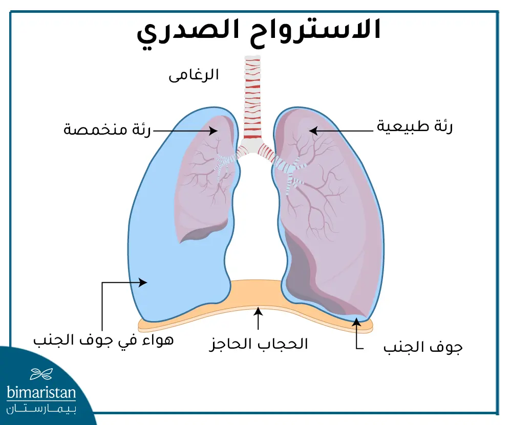 شكل الاسترواح الصدري الضاغط وتأثيره على الرئة
