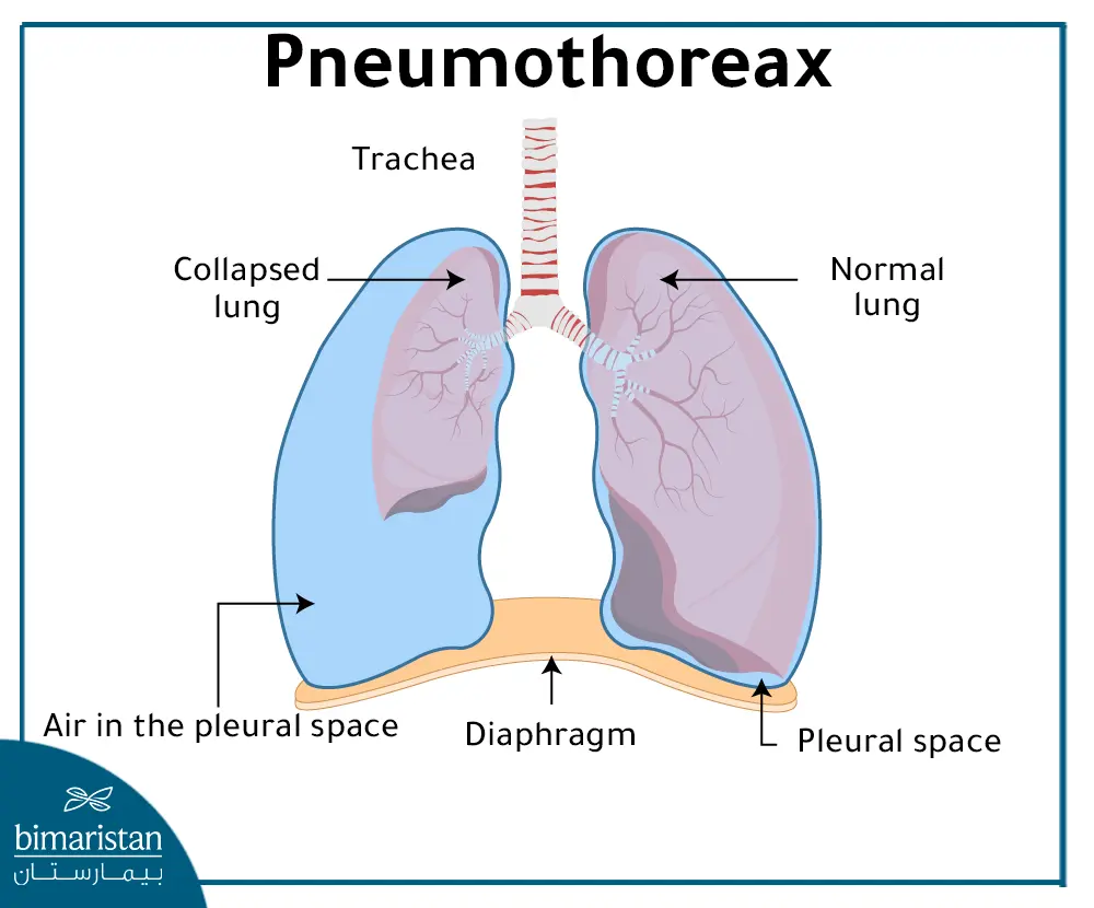 Tension Pneumothorax And Collapsed Lung