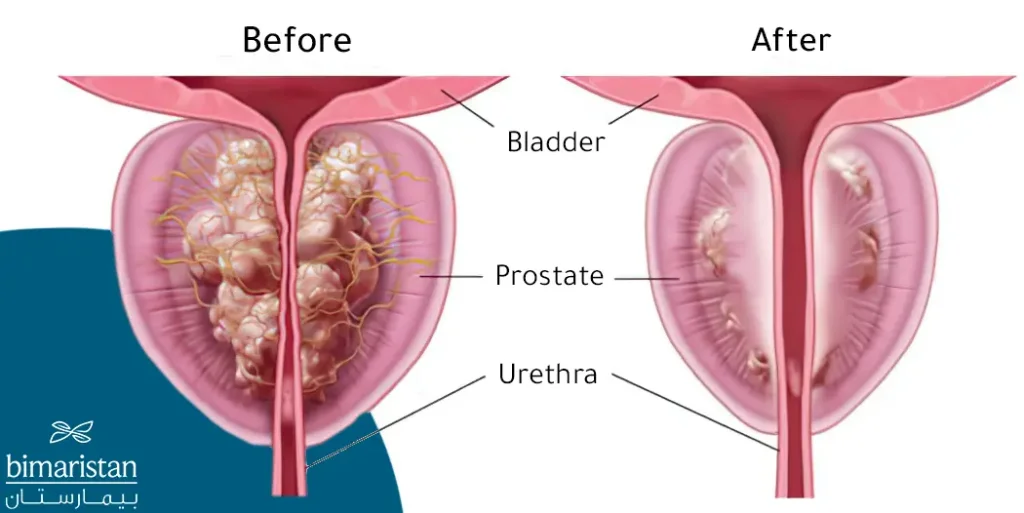 This is how prostate looks like Before and after treatment for prostate enlargement 