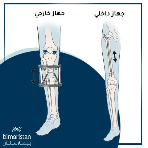 مقارنة بين جهاز تطويل العظام الداخلي وجهاز تطويل العظام الخارجي اللذان يستخدمان في علاج اختلاف طول الساقين