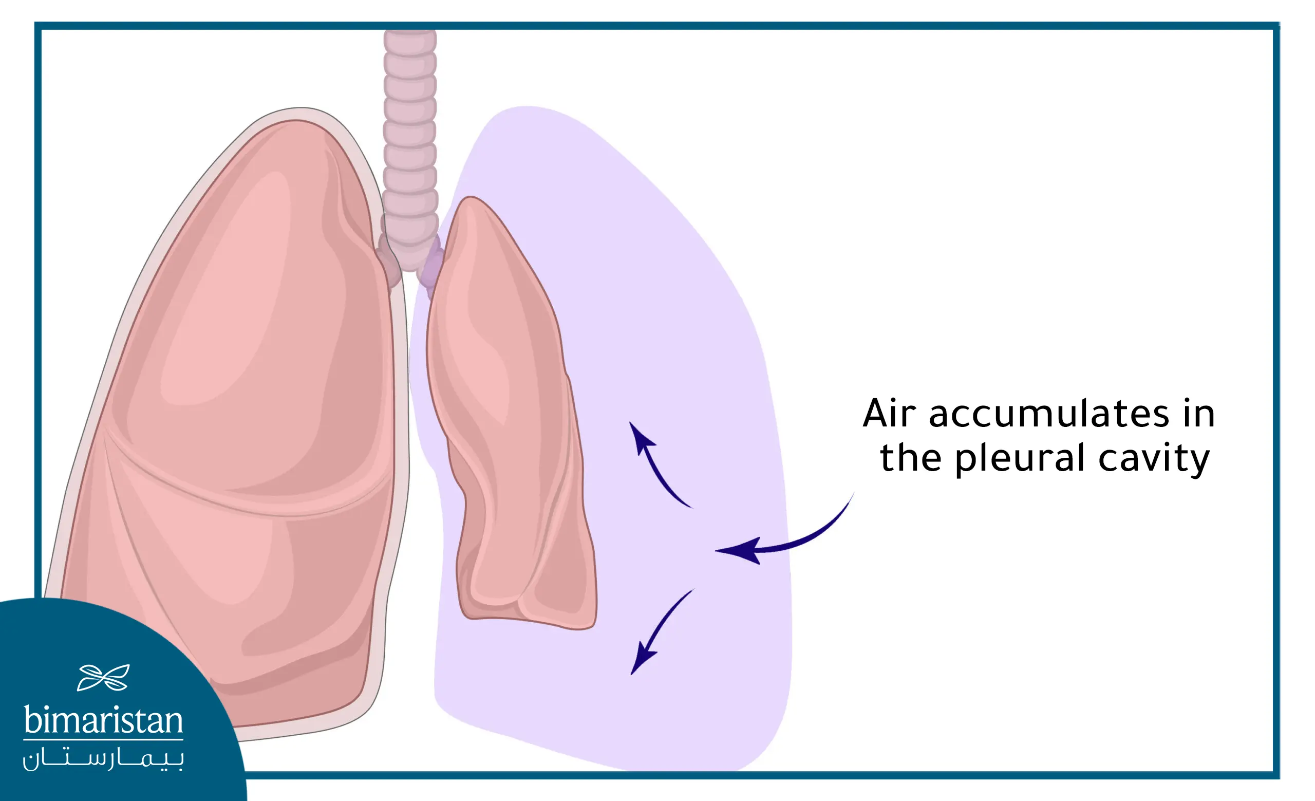 Pneumothorax: Symptoms And Treatment