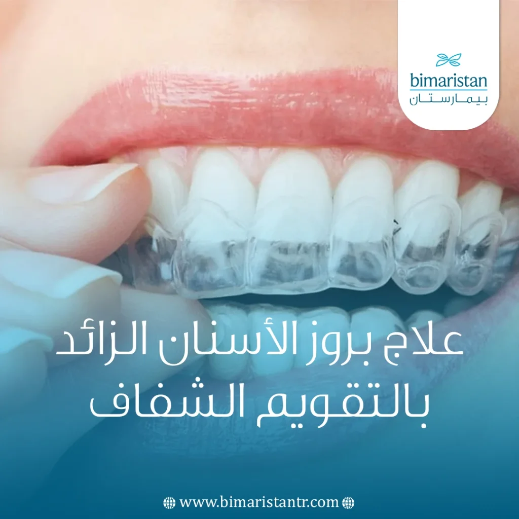 علاج بروز الأسنان الزائد بالتقويم الشفاف