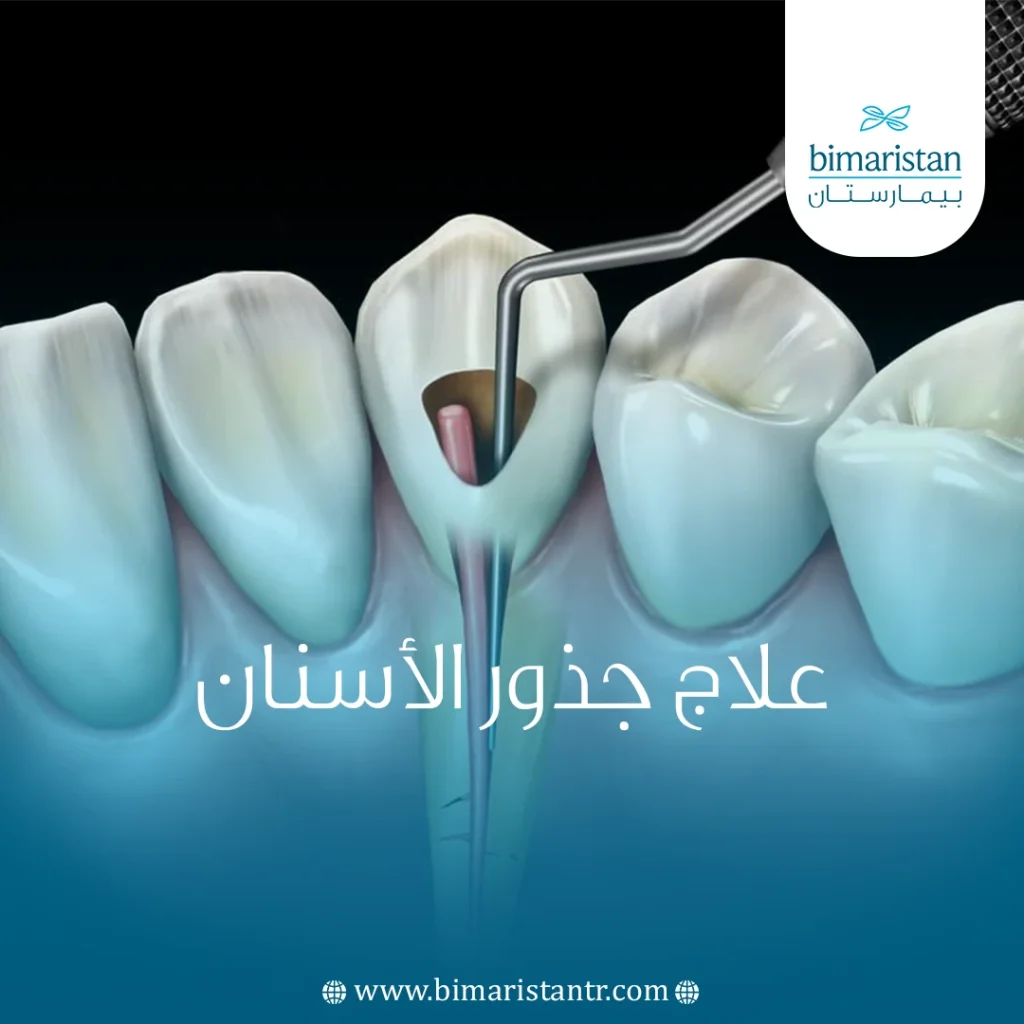 علاج جذور الأسنان