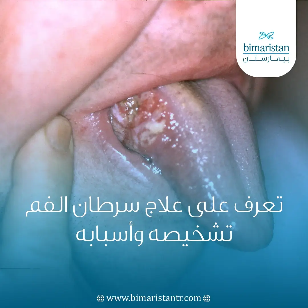 علاج سرطان الفم في تركيا