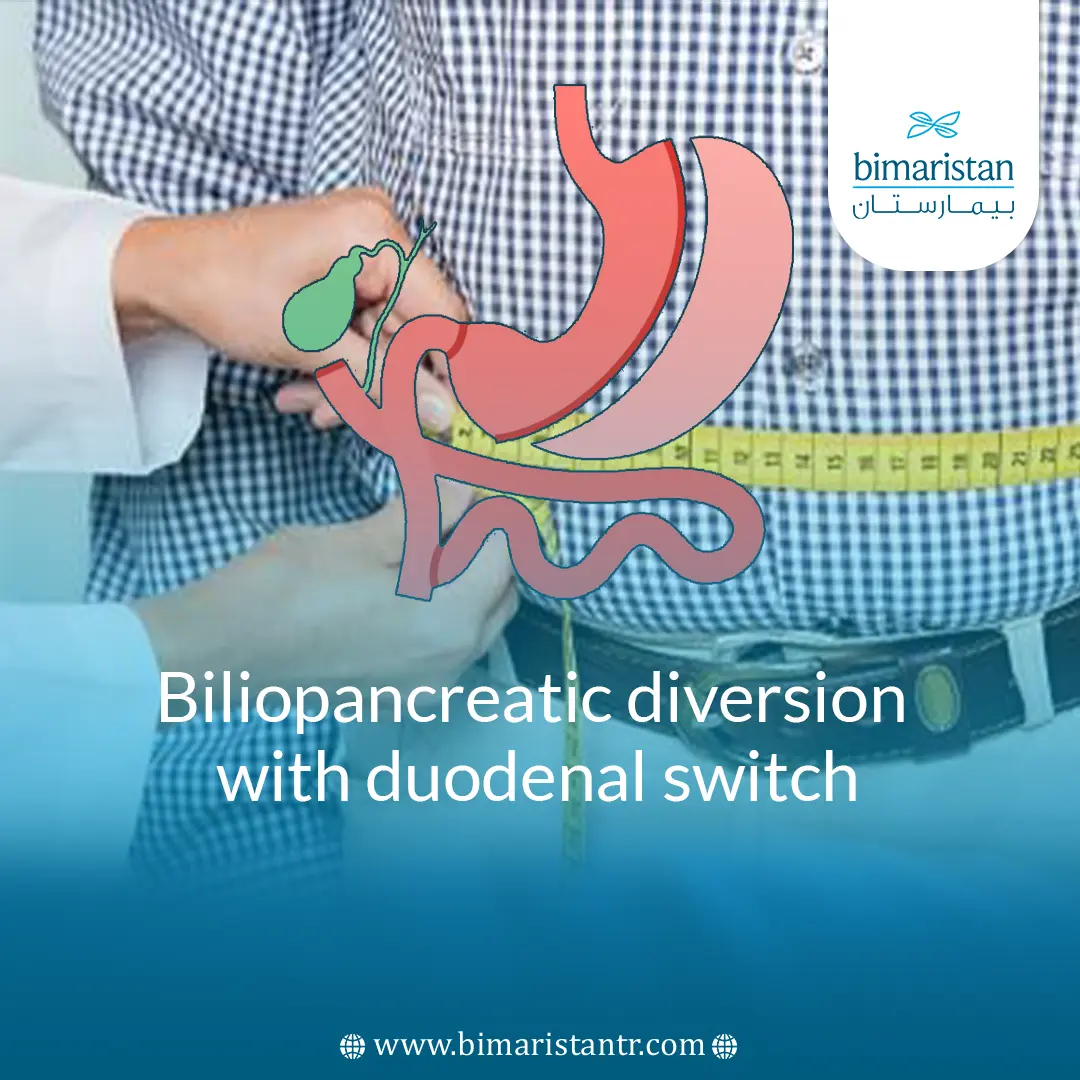 Biliopancreatic diversion with duodenal switch in turkey