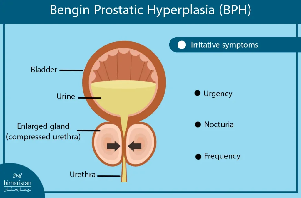 Symptoms Of Benign Prostatic Hyperplasia